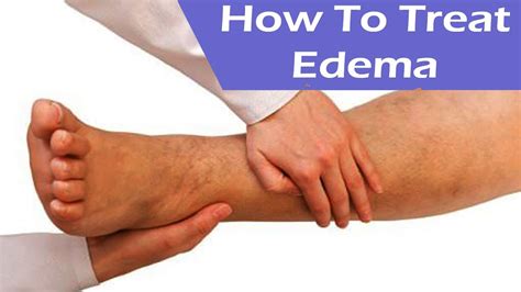 Edema - Causes, Flash Pulmonary, Corneal, Peripheral, Treatment