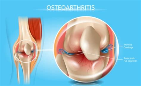 Diet for Osteopenia | Consumer Health Weekly