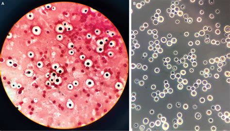 NEJM：新型隐球菌脑膜脑炎-病例报道-MedSci.cn