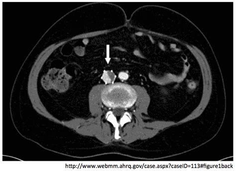 What is the evidence behind the IVC filter?