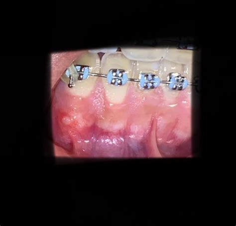 White Painful bump on gums? (More in comments) : r/braces