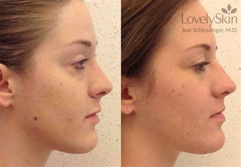 Mole Removal Before and After Photos