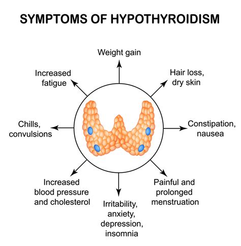 Hypothyroidism – Causes, Symptoms, Diagnosis, Treatment – Healthsoul