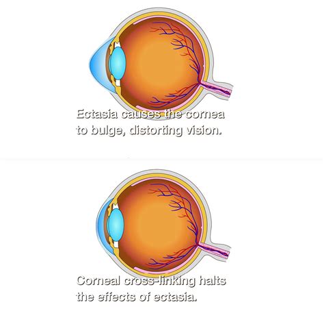 Corneal Cross Linking