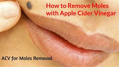 How to Remove Moles with Apple Cider Vinegar - YouTube