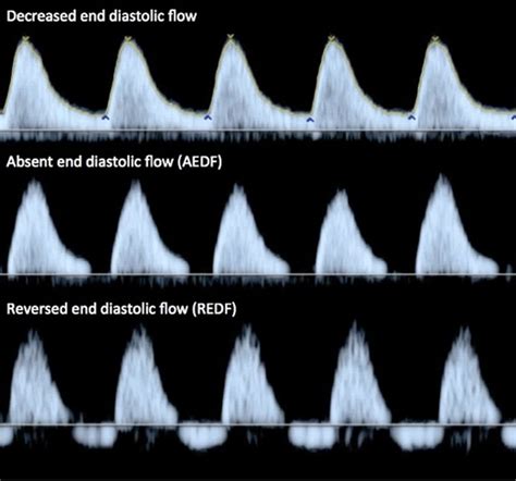 Progression of abnormal umbilical artery Doppler flow | Download Scientific Diagram