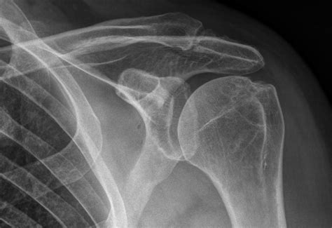 Acromioclavicular Joint X Ray