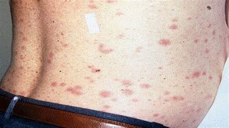 Typhus: Symptoms, Signs and Pictures | Health Digest