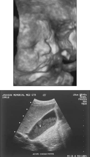 DIAGNOSTIC ULTRASOUND | Radiology Key