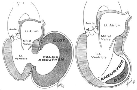 Dual presentation of a giant left ventricular pseudoaneurysm and true aneurysm. - Abstract ...