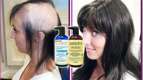 Best Shampoo For Hair Loss Uk Reddit A Comprehensive Guide - The 2023 ...