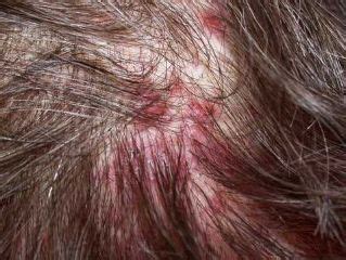 Itchy scalp no dandruff fungal infection | Scalp scabs, Pimples on ...