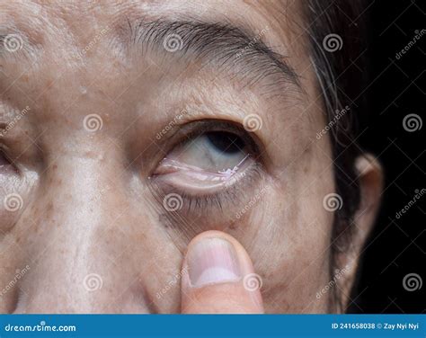 Pale Skin Of Asian Woman. Sign Of Anemia. Pallor At Eyelid Royalty-Free ...