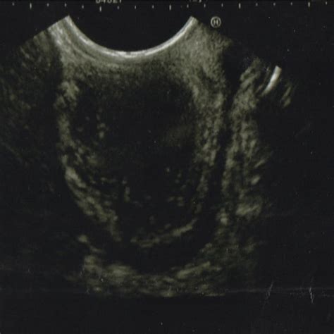 Gastroscopy showing a pre-pyloric sub-epithelial lesion (Arrow ...