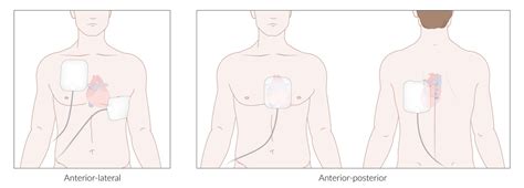 Automated External Defibrillator Pad Placement