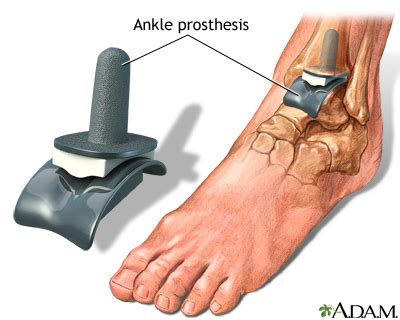 Ankle replacement: MedlinePlus Medical Encyclopedia Image