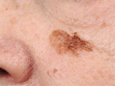 Lentigo maligna melanoma - Stock Image - C040/2880 - Science Photo Library