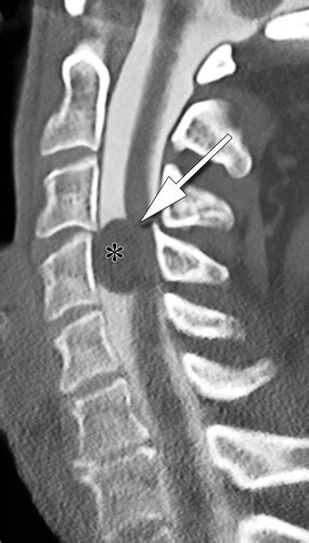 CT Myelogram Lumbar