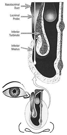 Ritleng Intubation System for Treatment of Congenital Nasolacrimal Duct Obstruction | Congenital ...