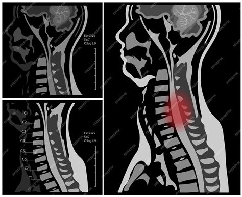 Premium Vector | Mri of the cervical spine with and without contrast, mri with bilateral c7 root ...