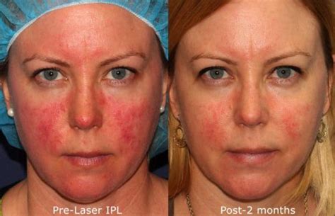 Why Everyone Needs an IPL Treatment - Cosmetic Laser Dermatology Skin ...