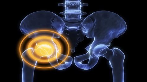 Was ist eine Coxarthrose? - Was ist eine Arthrose