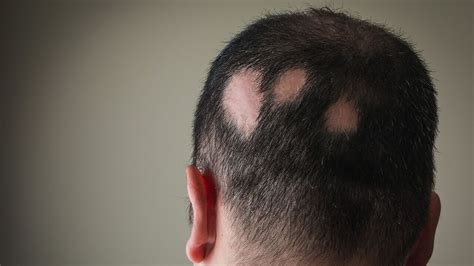 Alopecia Areata and Hair Loss: Causes, Symptoms, Treatment – The Amino Company