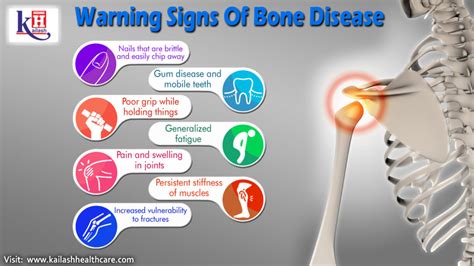 Warning Signs of Bone Disease