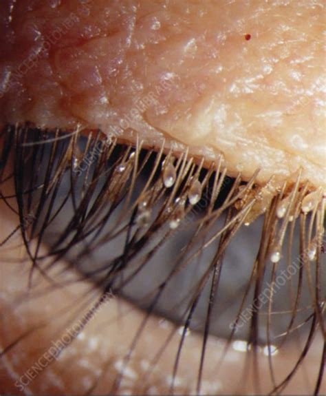 Lice in Eyes & Eyelashes | In-Home Head Lice Removal