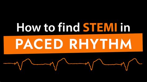 Sgarbossa Criteria for Ventricular Paced Rhythm | scanFOAM