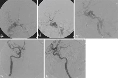 Endovascular Treatment of Head and Neck Bleeding - Clinical Tree