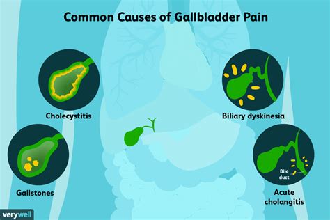 Gallbladder Pain Causes and Treatment (2022)