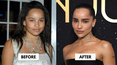 Zoe Kravitz's Plastic Surgery: Continues To Astound Us All!