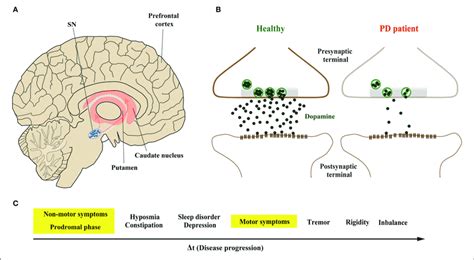 Parkinson´s Disease (PD) | ANOVA IRM Germany