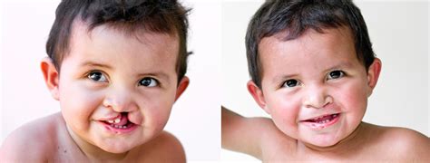 Daniel from Brazil before and after cleft lip surgery. www.operationsmile.org Lip Surgery ...