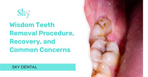 Wisdom Teeth Removal Procedure, Recovery, and Common Concerns