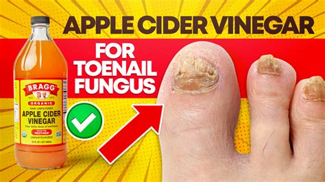 How Effective is Apple Cider Vinegar for Toenail Fungus? | Cure Toenail Fungus Fast