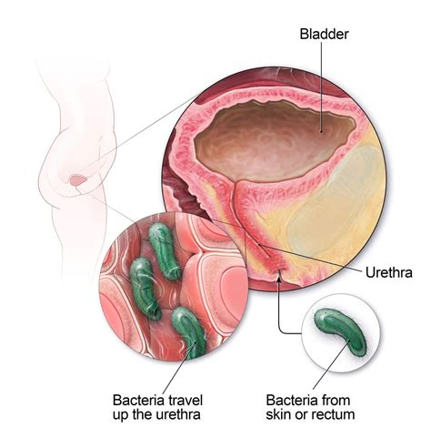 Urinary Tract Infection - Medix Urgent Care & Family Health Center