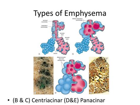 Google what is emphysema: Emphysema – Symptoms and causes