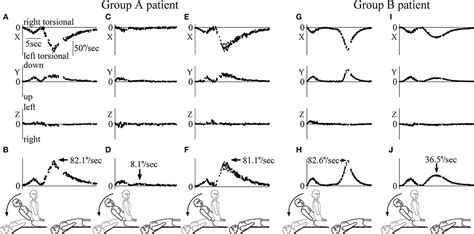 Frontiers | Effects of Interval Time of the Epley Maneuver on Immediate Reduction of Positional ...