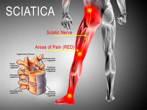 Sciatica Pain - Carolinas Pain Center - Pain in your back felt in legs