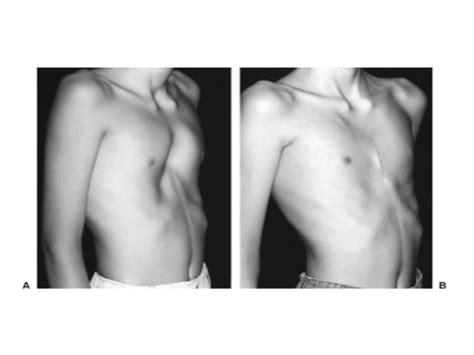 Chest wall deformities