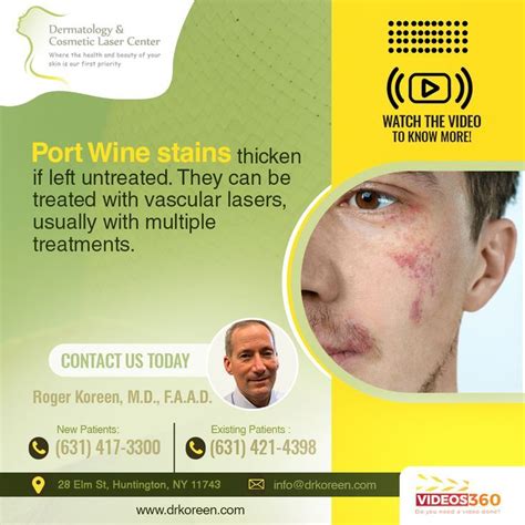 Port Wine Stains | Port wine stain, Wine stains, Dermatology