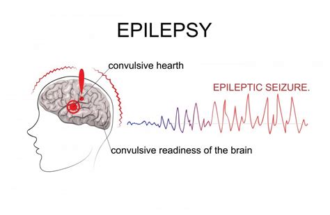 Epilepsy : Causes, symptoms, and treatment - GreenBHL