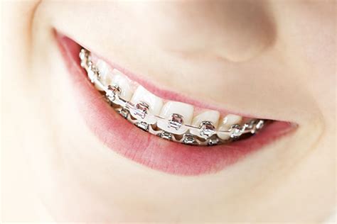 Silver Braces Bands Archives - Marninixon