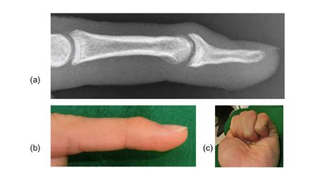 Conservative Treatment of Chronic Mallet Fracture Non-union after ...