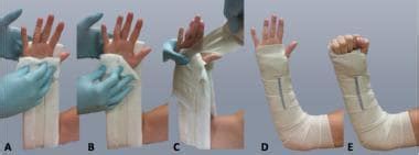 Sugar-Tong Forearm Splinting Technique: Application of Sugar-Tong Splint, Postprocedural Care ...