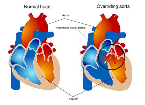 Overriding aorta - wikidoc