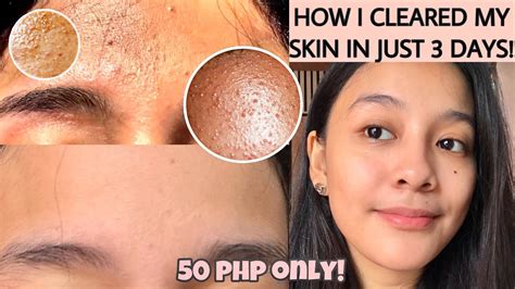 HOW TO GET RID OF TINY BUMPS ON FOREHEAD/FACE FAST | FUNGAL ACNE (how i cleared my skin) [ENG ...