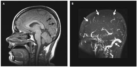 MRI of Sinus Thrombosis.In Panel A, a T1-weighted MRI scan obtained... | Download Scientific Diagram